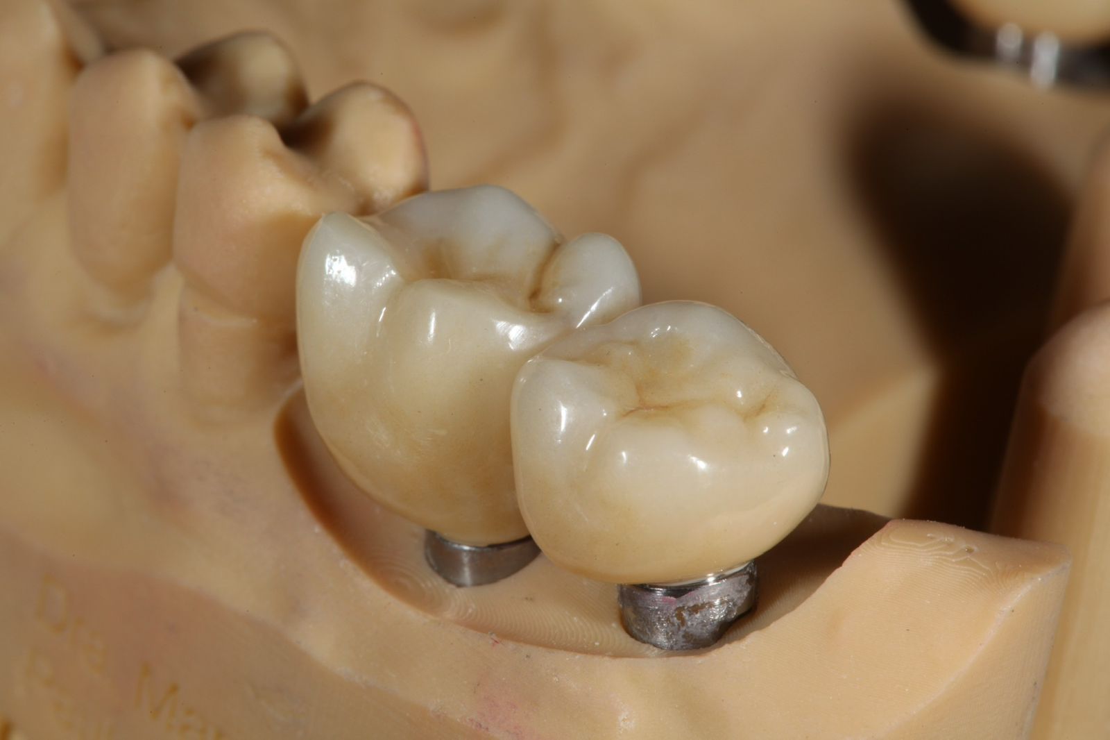 Implantes dentários